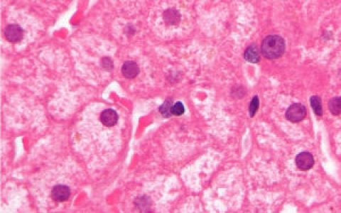 乙肝病毒携带者(肝功能基本正常的慢性HBV感染者)