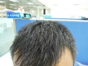 遗传性白发(受遗传基因影响的先天性白发现象)