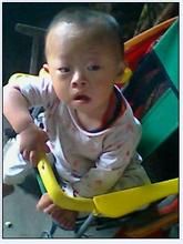 1三体综合症(染色体异常而导致的疾病)"