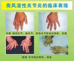 内风湿(长期进行凉水的接触或风吹导致的病例)