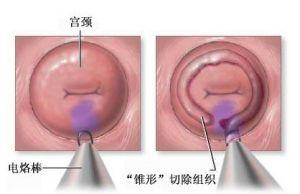 宫颈增生(性的宫颈炎症刺激引起的肥大)