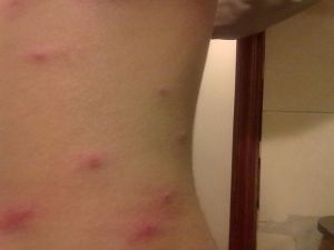水疱疹(疱疹病毒感染引起的疾病)