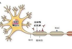 吉兰巴雷综合征(自身免疫性周围神经病)