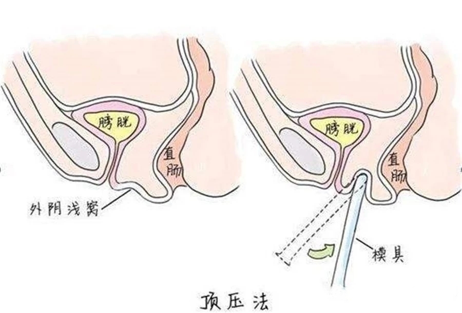 石女(生殖器官发育异常的女性)