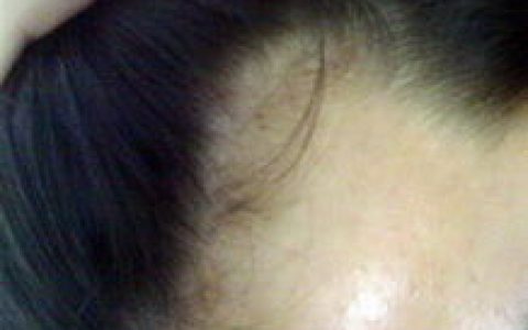 男性脱发(雄激素源性脱发（AGA）)