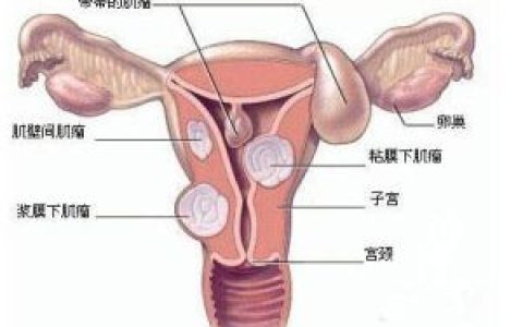子宫肌瘤手术(子宫内切除肌瘤手术)