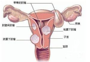 子宫肌瘤手术(子宫内切除肌瘤手术)