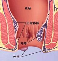 外痔(肛门疾病)
