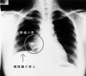 肺癌(恶性肿瘤)
