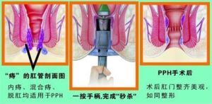 pph痔疮手术(医学术语)