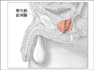 前列腺增大(一种疾病)