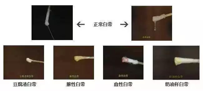 白带带血(指白带中混有血)