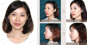 隆鼻后遗症(一种疾病)