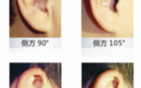 隐形助听器(听力辅助工具)