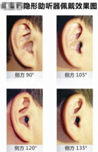 隐形助听器(听力辅助工具)