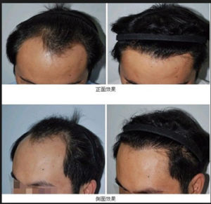 毛发移植(医疗手段)