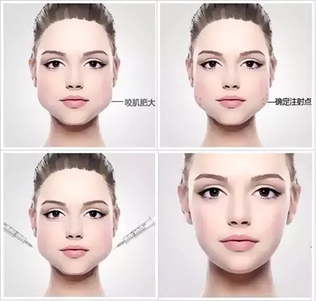 botox瘦脸针(美容材料)