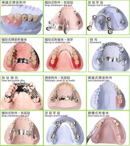 可摘局部义齿(牙齿修复方法)