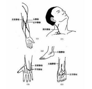 静脉注射(医学医疗方法)