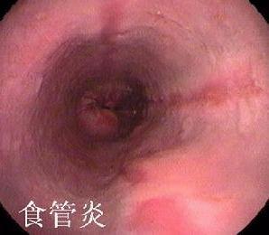 反流性食管炎(胃食管反流病)
