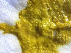 奶瓣(宝宝大便中有白色颗粒或瓣状物)