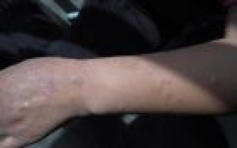 银屑病(慢性炎症性皮肤病)