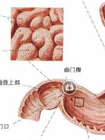 急性胃出血(医学病理名称)