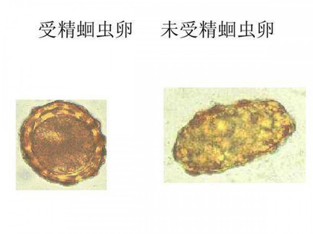 肠道蛔虫症(蛔虫寄生于人体小肠内所引起的疾病)