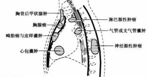 纵隔肿瘤(多见于原发性肺部恶性肿瘤)