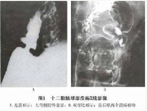十二指肠溃疡(一种消化系统疾病)