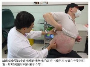 急性荨麻疹(临床常见病)