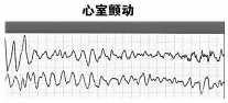 电除颤(治疗心室纤颤的有效方法)