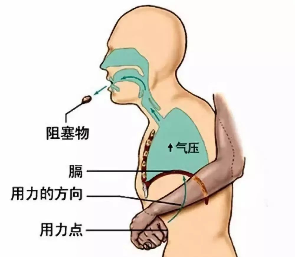 海姆立克急救法(抢救气管异物患者的急救方法)