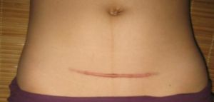 剖腹产疤痕(剖腹分娩手术后留下的痕迹)