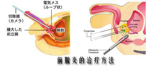 前列腺炎治疗(泌尿外科的常见病的治疗)