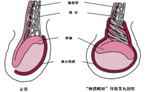 睾丸扭转(精索扭转)