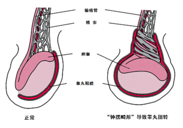 睾丸扭转(精索扭转)