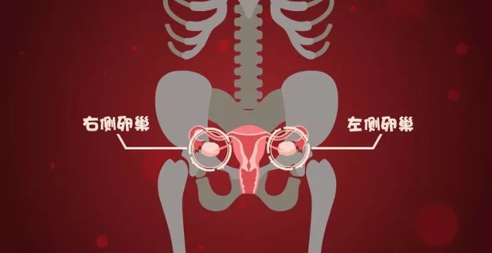 双侧多囊卵巢(妇科疾病)