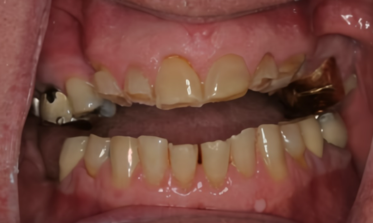 磨牙症(口腔科的常见病和多发病)