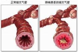 支气管炎(慢性非特异性炎症)