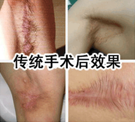 狐臭手术(腋臭去除方式)