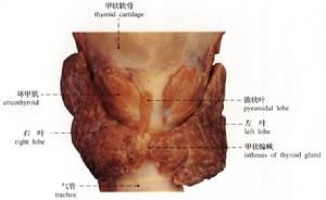 桥本甲状腺炎(一种自体免疫性疾病)