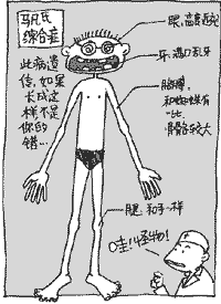 马凡氏综合症(一种先天性遗传性结缔组织疾病)