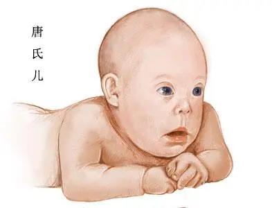唐氏病(唐氏综合征)