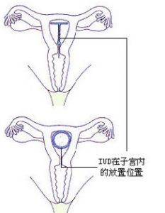 上环(我国育龄期妇女最常用的长效避孕措施)