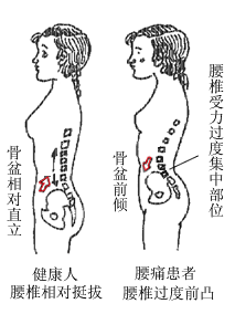 骨盆前倾(骨盆位置偏移的病态现象)