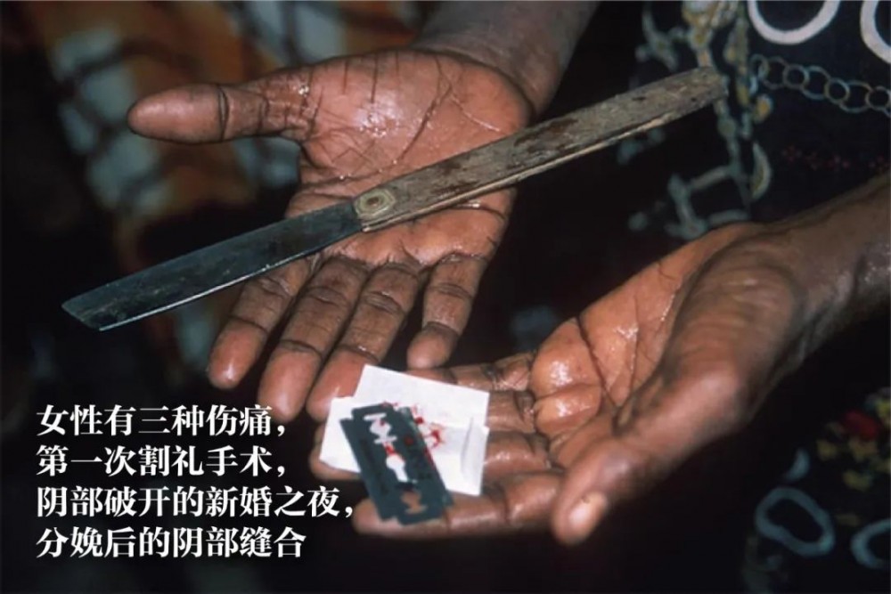 割礼(一种民族或宗教习俗)
