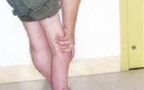 小儿麻痹后遗症(一种由病毒引起的急性传染病)