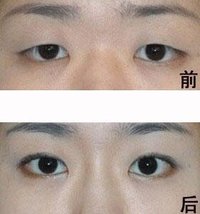 三点定位双眼皮(也称为韩式三点双眼皮)