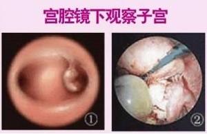 宫腔镜手术(用宫腔镜来进行的微创手术)